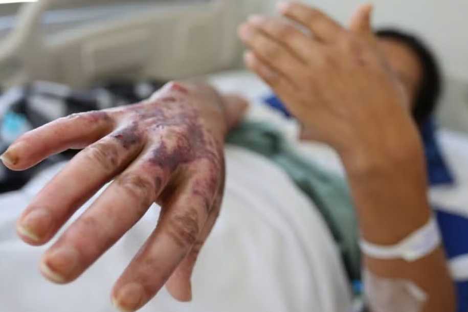 Internações na Unidade de Tratamento de Queimados aumentam 65% no primeiro semestre do ano em Catanduva