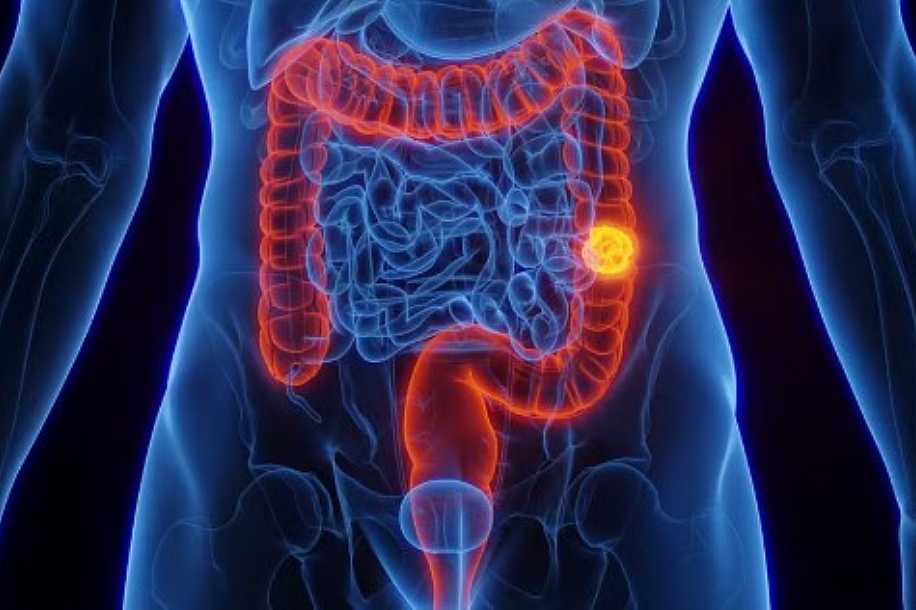 SUS adota novo exame para detectar câncer de intestino antes dos sintomas