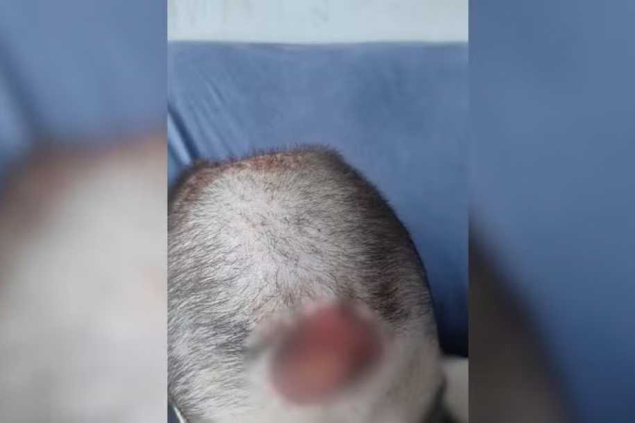 Adolescente autista com ferida exposta na cabeça passa por cirurgia após esperar quase um mês