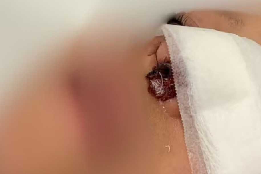 Criança sofre fratura no nariz e passa por cirurgia após ser empurrada em escola de Araçatuba: ‘Estou arrasado’, diz pai