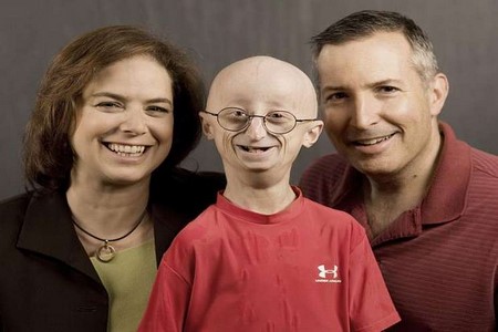 Com doença rara, americano morre aos 17 anos de ”velhice”