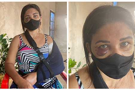 Funcionária de padaria tem braço quebrado por cliente após pedir para homem usar máscara contra a Covid
