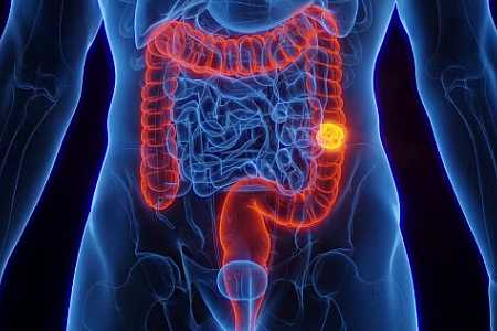 SUS adota novo exame para detectar câncer de intestino antes dos sintomas