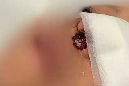 Criança sofre fratura no nariz e passa por cirurgia após ser empurrada em escola de Araçatuba: ‘Estou arrasado’, diz pai