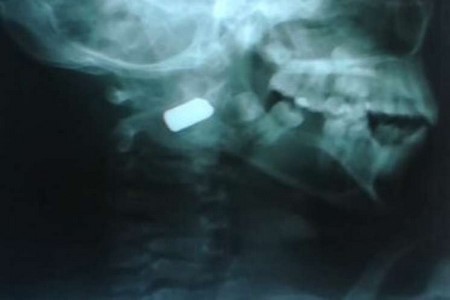 Menino que passou 60 horas com bala na nuca diz que ´nasceu de novo´