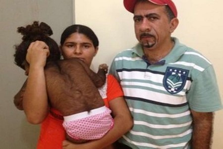 Menina com corpo coberto de pelos viaja 25h de ônibus para tratamento
